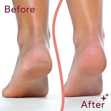 Callus Remover – مزيل الجلد الميت